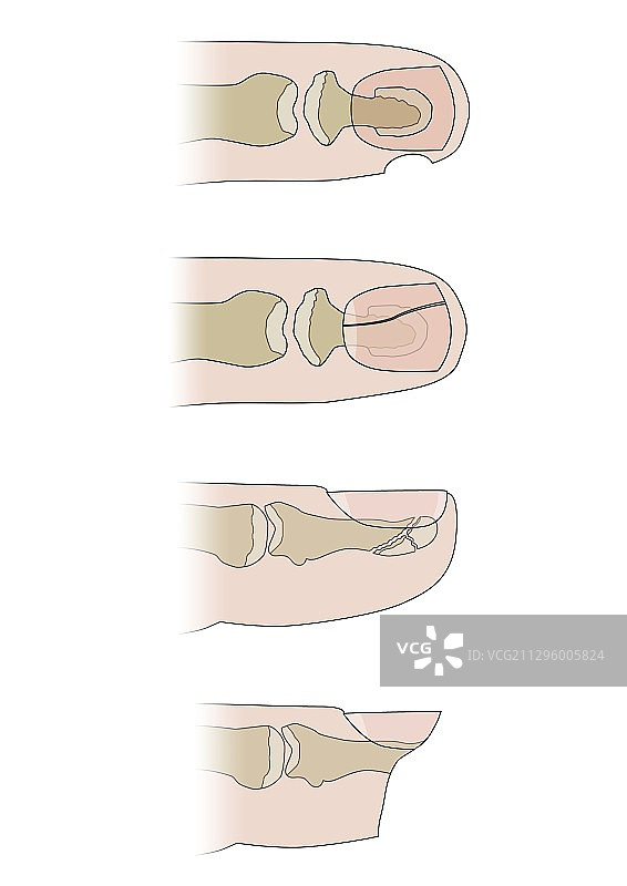 指尖受伤插画图片素材