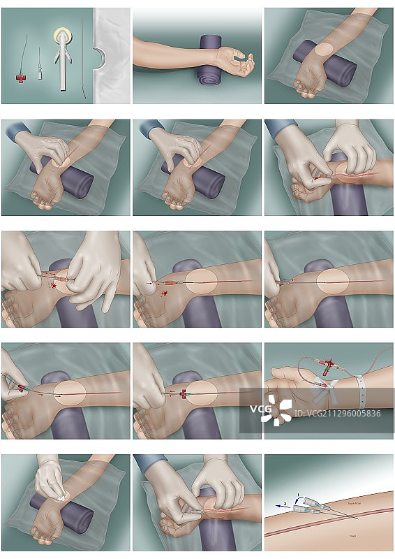 动脉置管插画图片素材