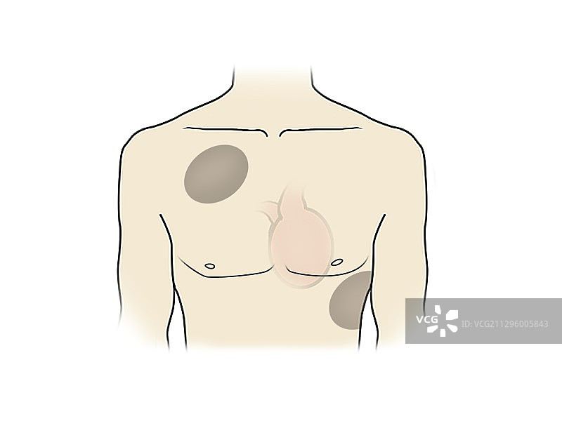 除颤器电极片位置示意图图片素材