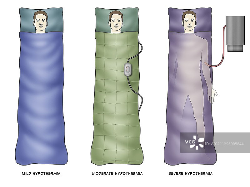 低温症治疗方法，图示图片素材