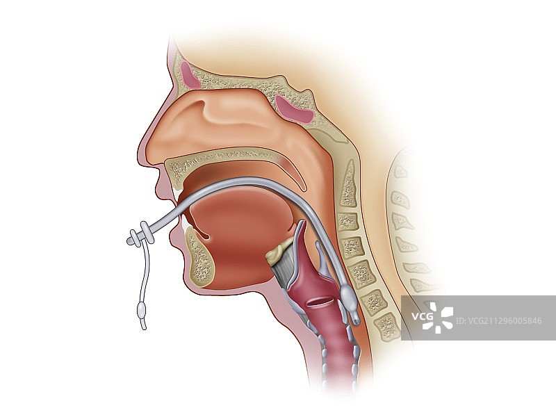 口鼻气管插管图示图片素材