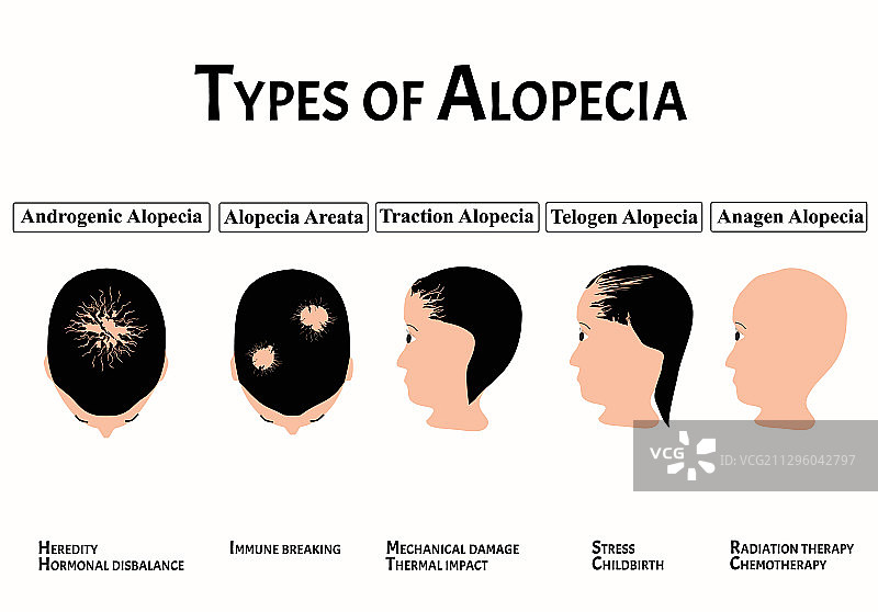 脱发秃顶斑秃类型图片素材
