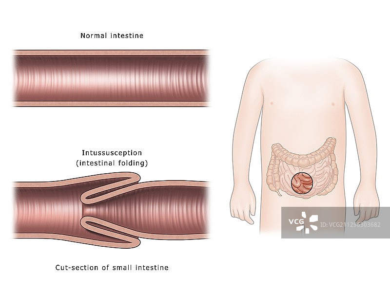 肠套叠插图图片素材