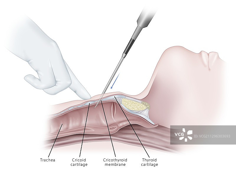 环甲膜切开术气道穿刺，图示图片素材