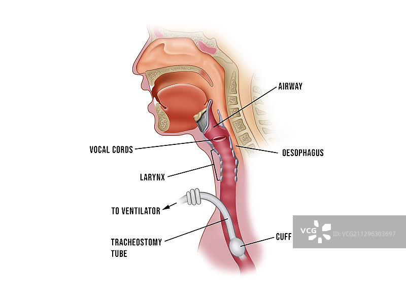 气管切开气道插管示意图图片素材