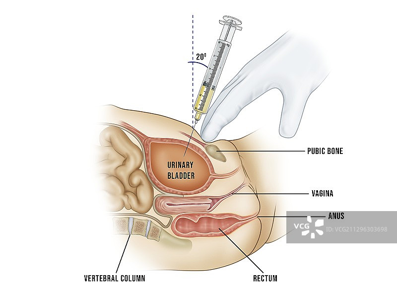 膀胱上穿刺取尿液样本插图图片素材