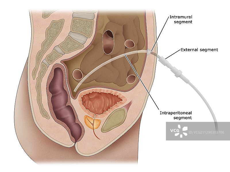 腹膜透析图示图片素材