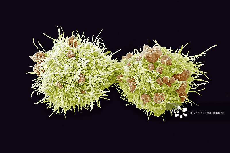 宫颈癌细胞分裂，扫描电镜图片素材