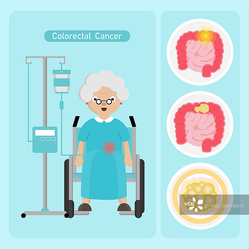 患有结直肠癌的老年女病人图片素材