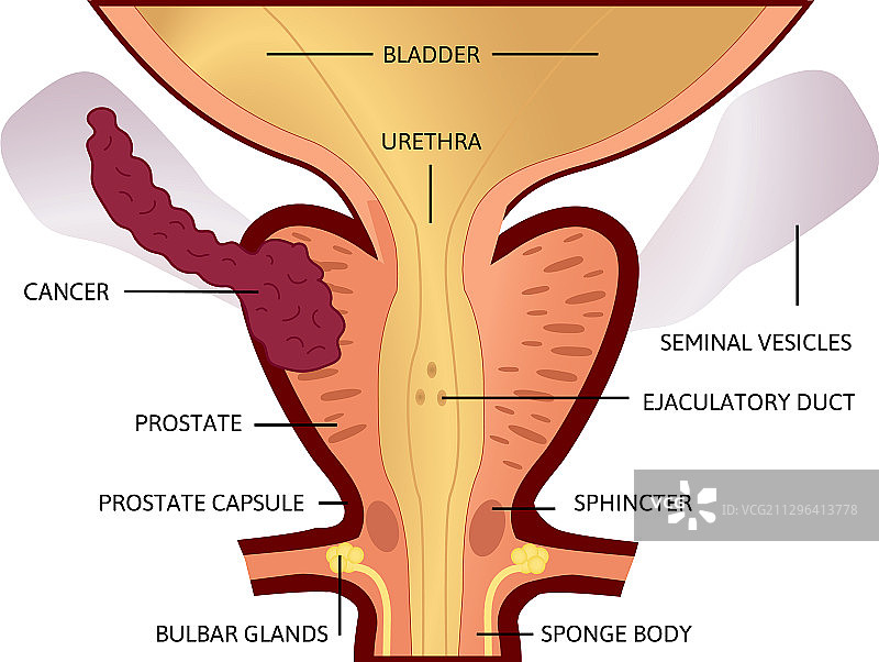 前列腺癌第三期肿瘤增大图片素材