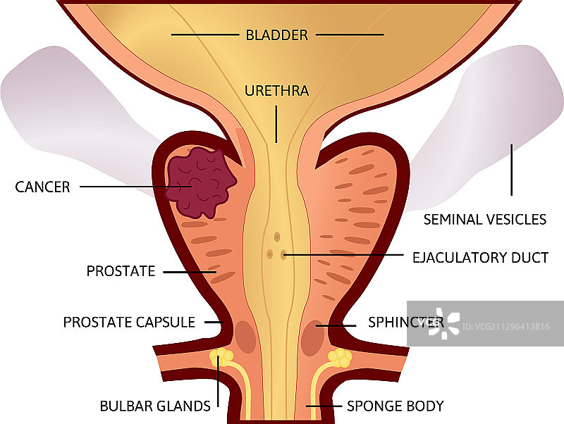 前列腺癌二期肿瘤较大图片素材