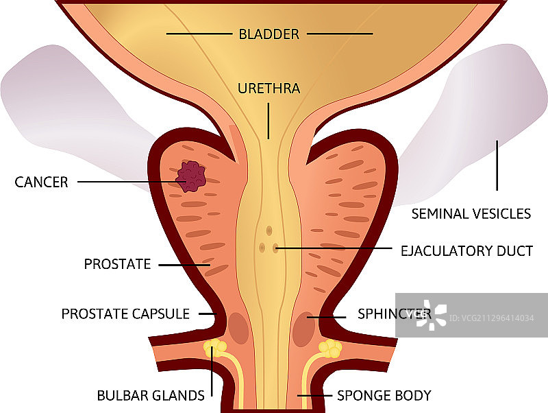 早期前列腺癌，肿瘤较小图片素材