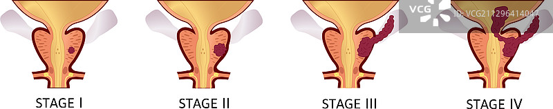 前列腺癌的I至IV期图片素材