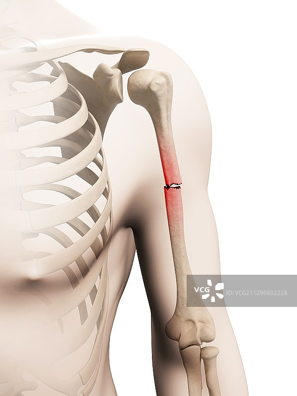 手臂骨折插画图片素材