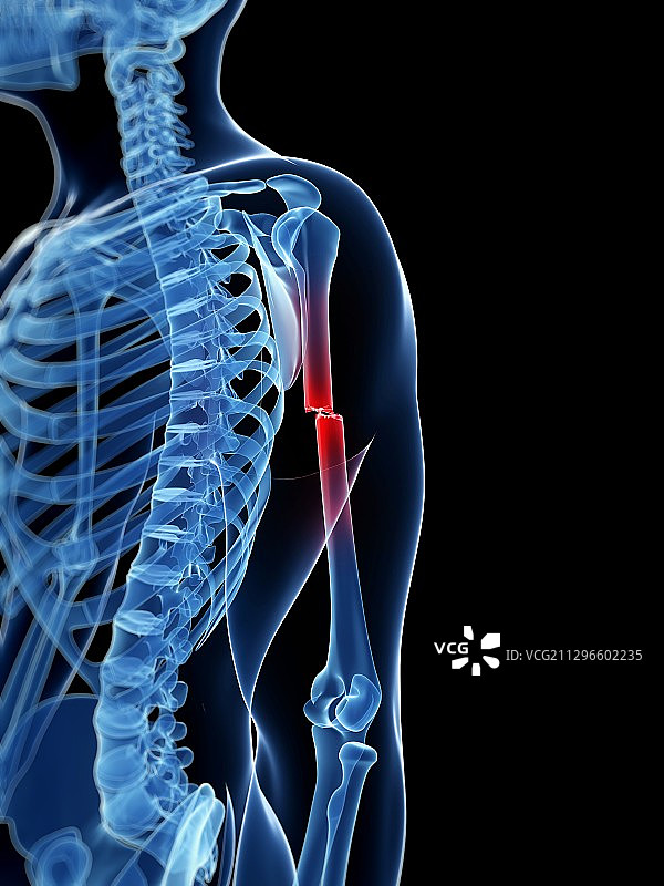 手臂骨折插画图片素材