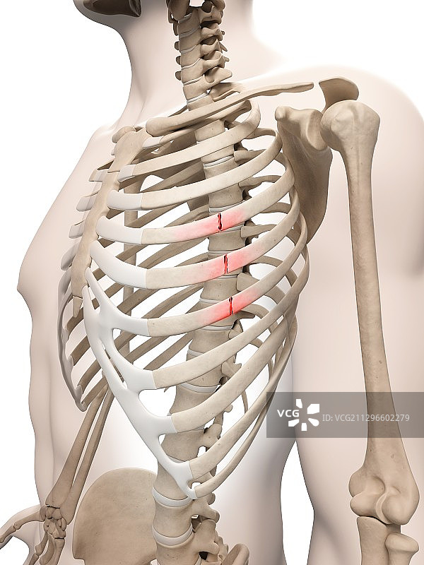 断裂的肋骨插图图片素材