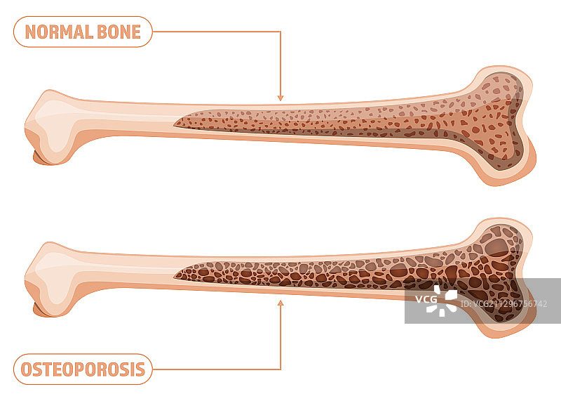 骨质疏松症设计图片素材