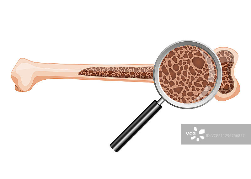 骨质疏松症设计图片素材