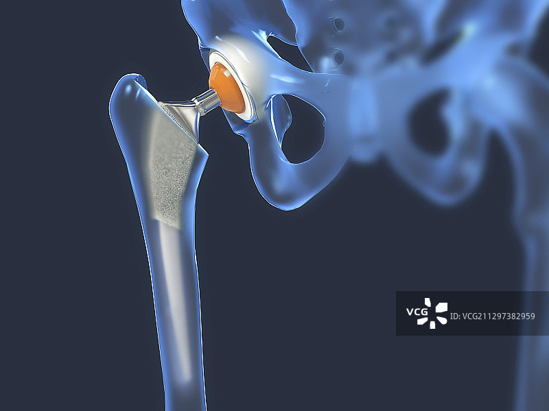 髋关节置换术插图图片素材