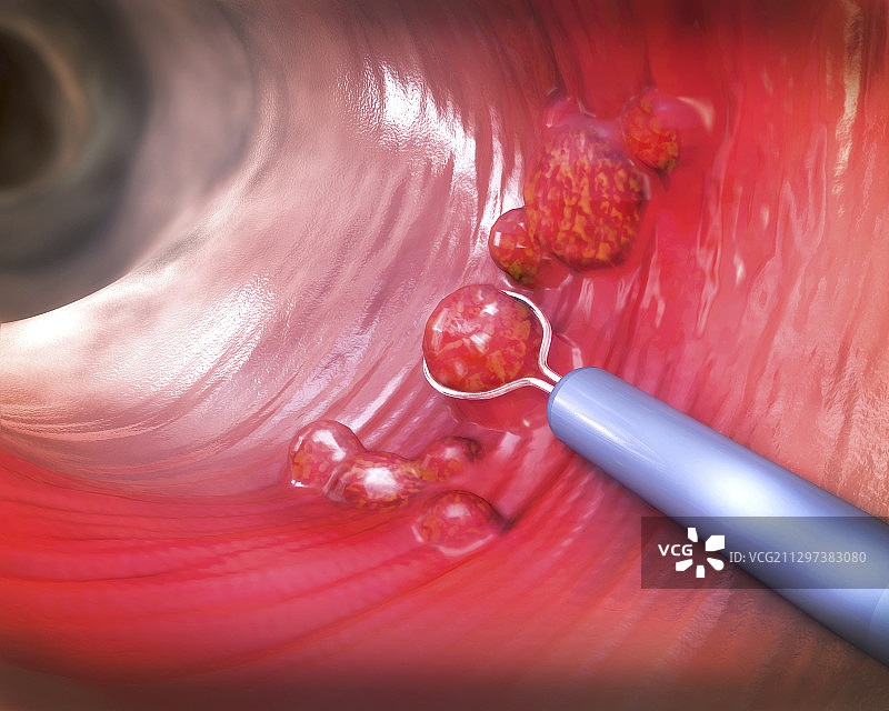 息肉切除示意图图片素材