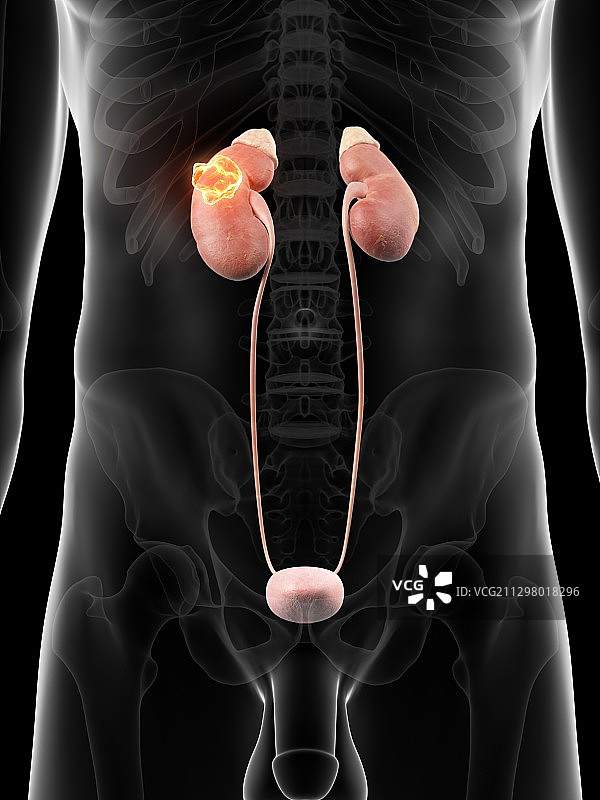 患癌的人类肾脏图片素材