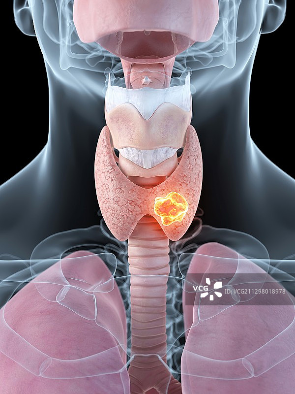 甲状腺肿瘤医学插画图片素材