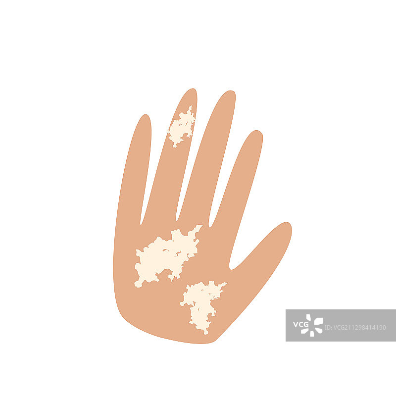 手部白癜风图片素材