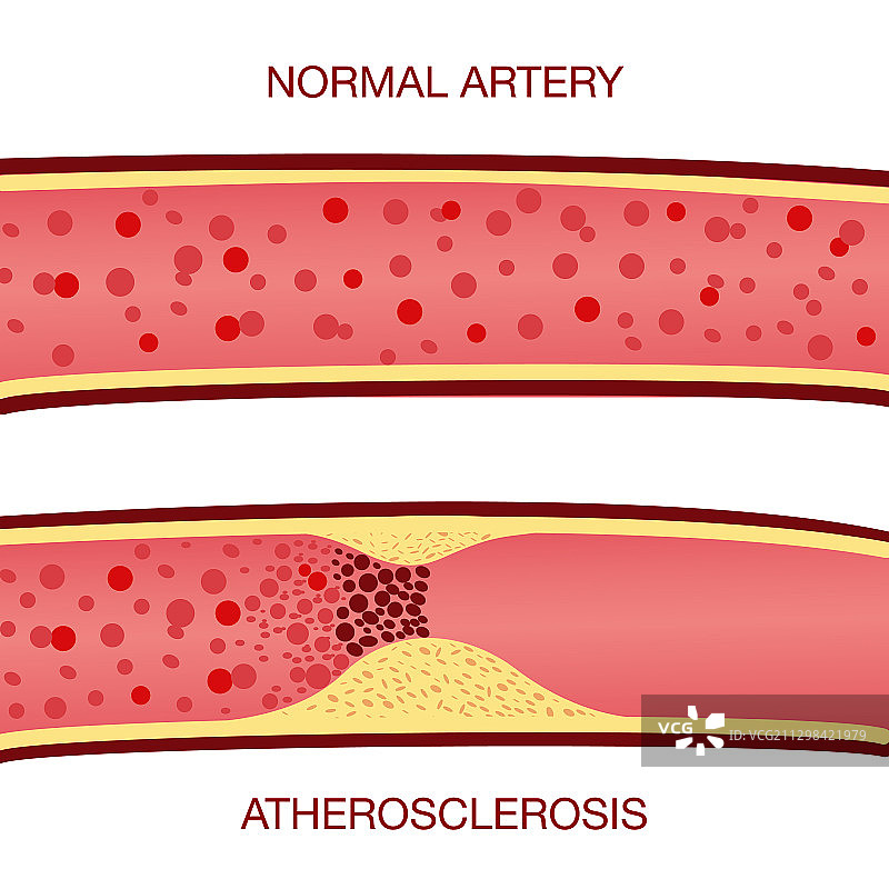 动脉粥样硬化中的胆固醇斑块图片素材