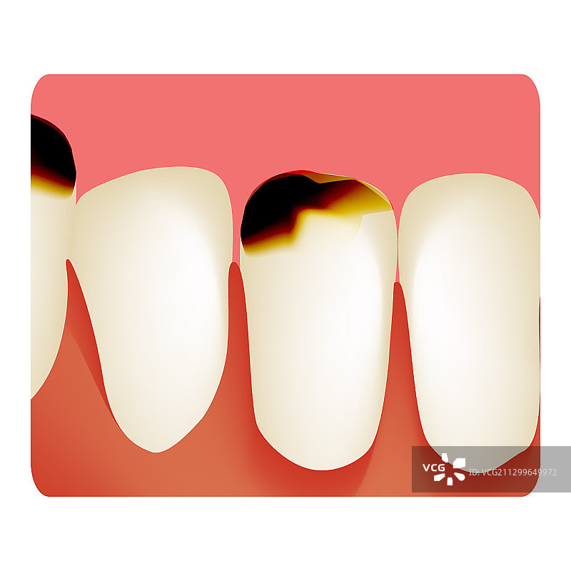 龋齿牙齿腐烂信息图图片素材