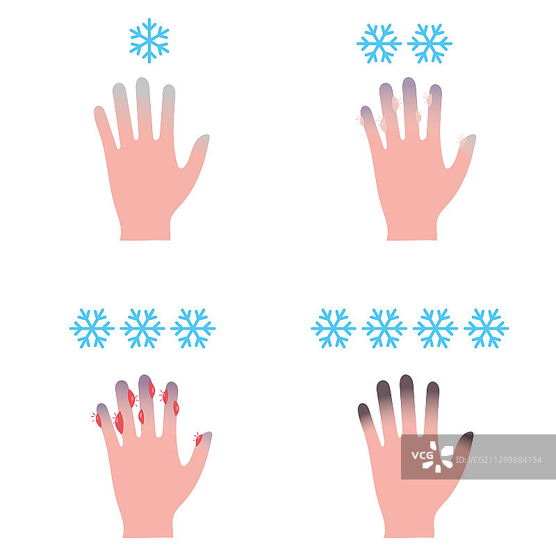 冻伤阶段医学信息图图片素材