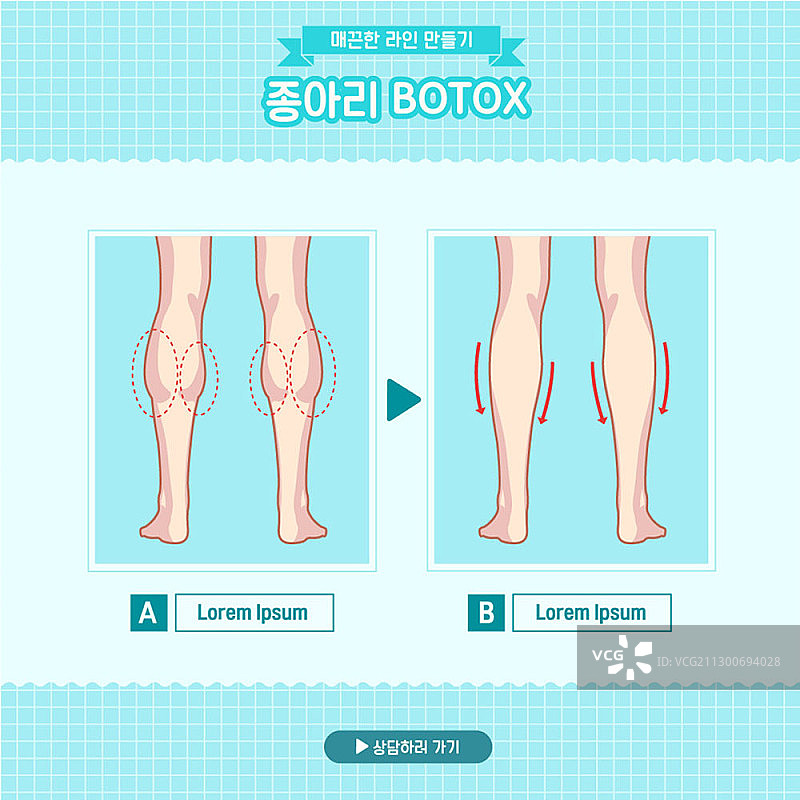 小腿肉毒杆菌治疗前后图片素材