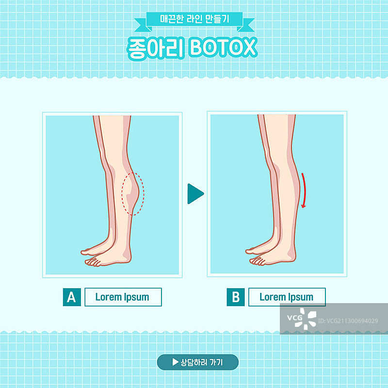 小腿肉毒杆菌治疗前后图片素材