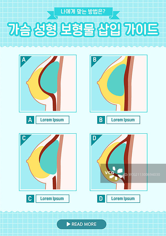 乳房植入体插入指南图片素材