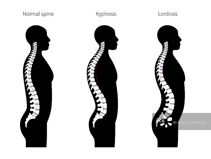 脊柱后凸前凸图片素材