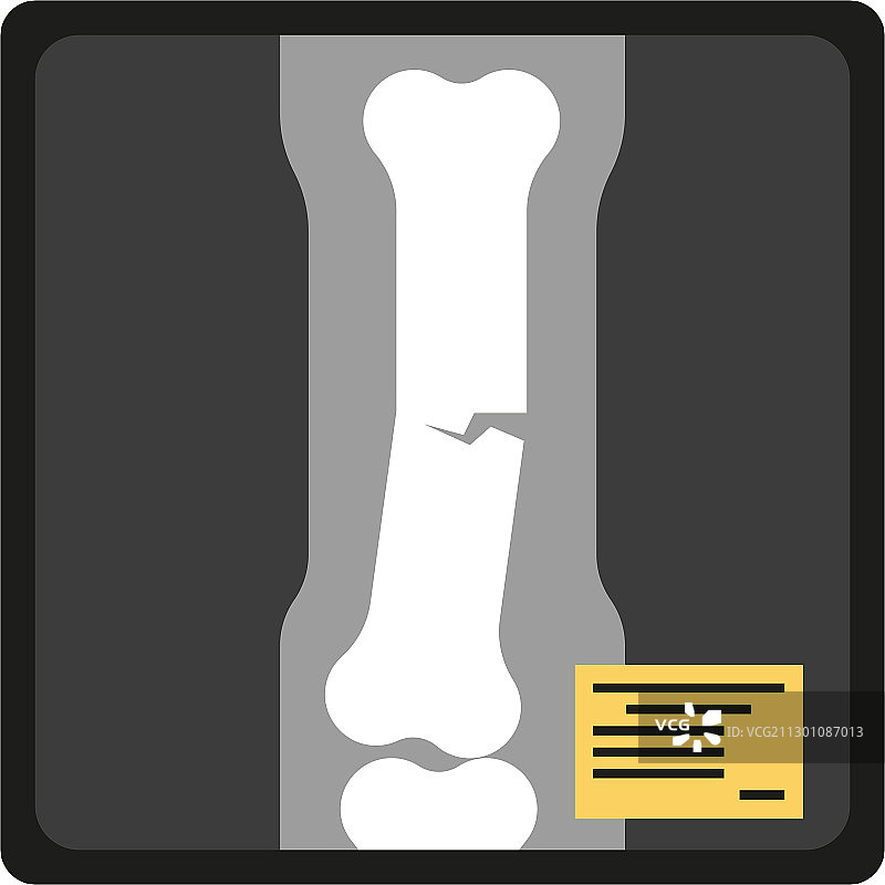 骨折X光图片（扁平风格）图片素材