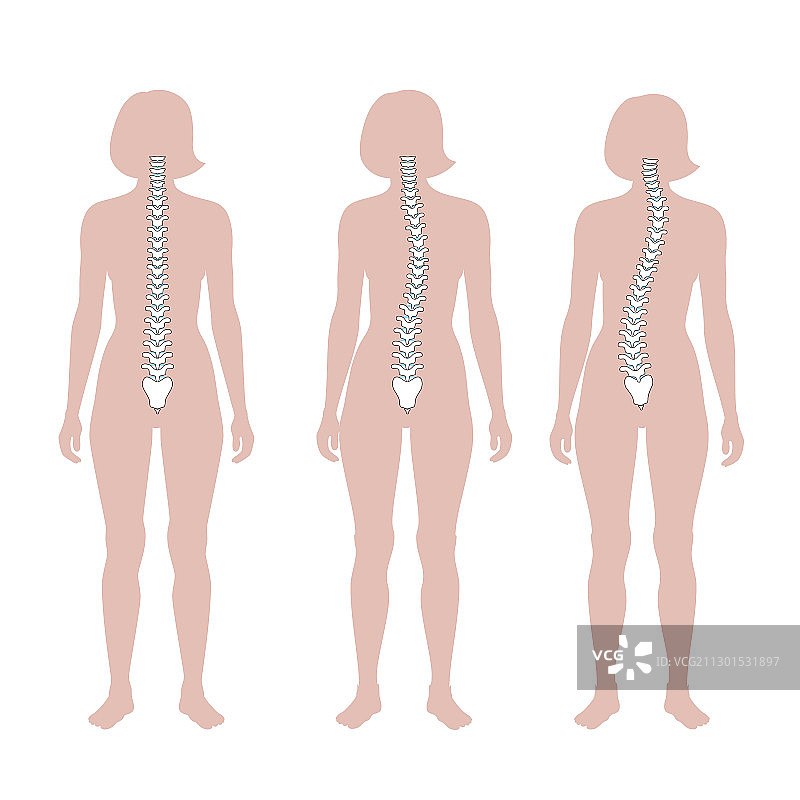 脊柱侧弯扁平风格图片素材
