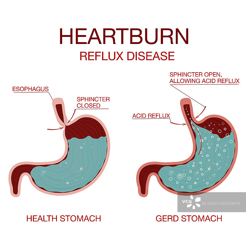 胃灼热胃病消化不良和胃图片素材