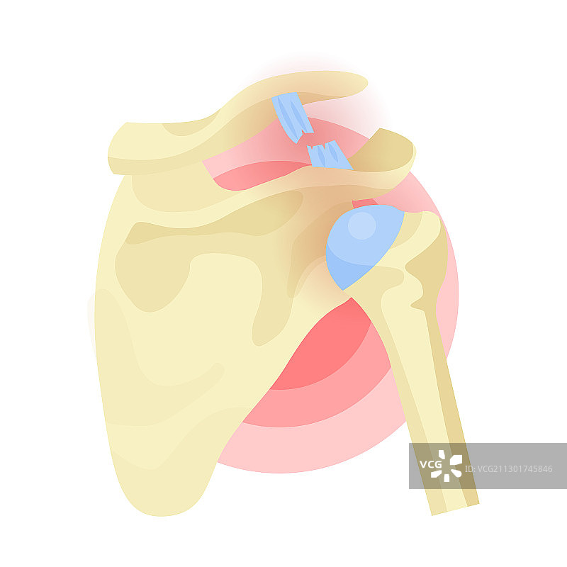 肩部脱位断裂的肌腱韧带图片素材