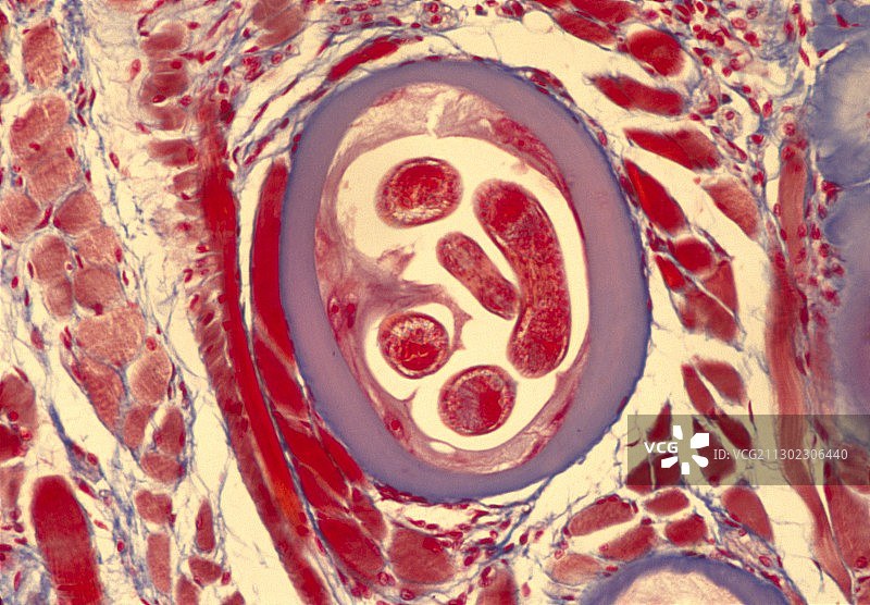 由旋毛虫引起的囊肿的LM图片素材