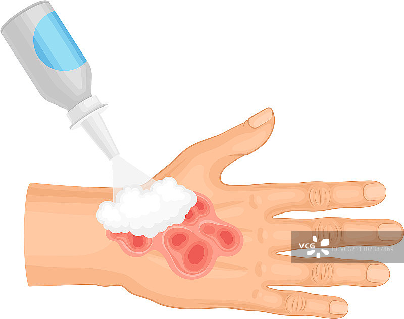 手部烧伤急救图片素材