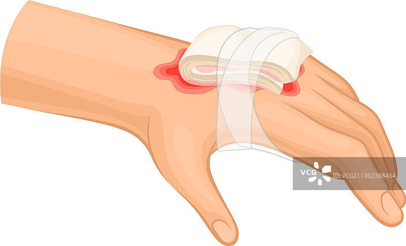 手部烧伤急救图片素材