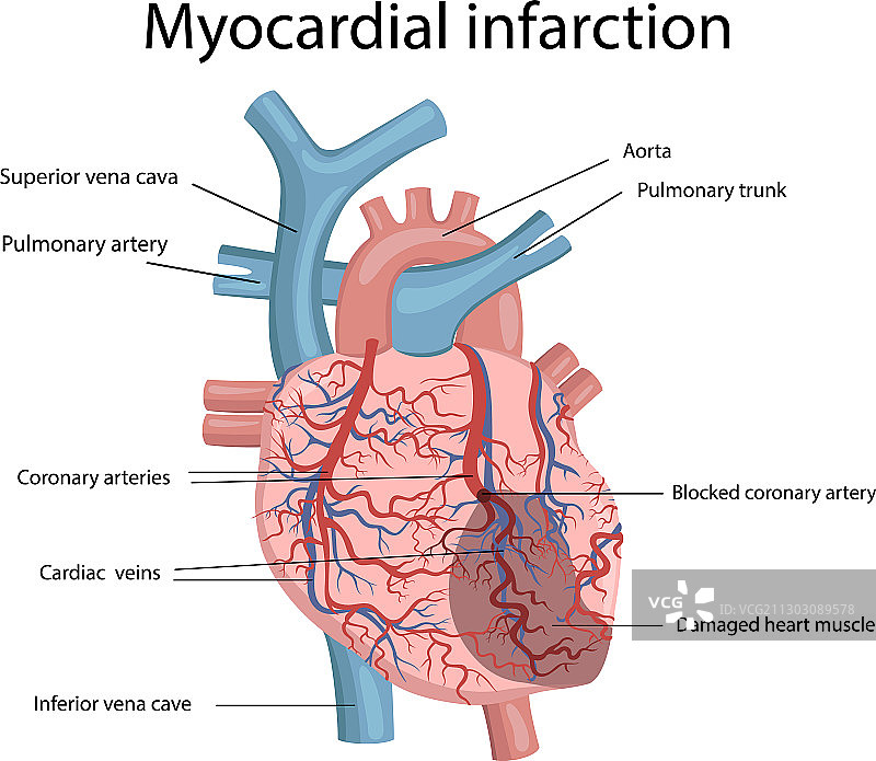 心肌梗塞图片素材