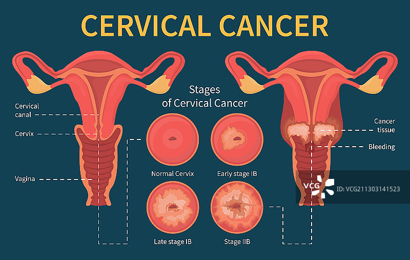 女性宫颈癌分期信息图方案图片素材