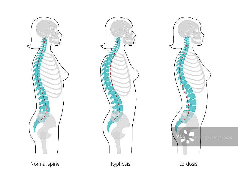 脊柱后凸前凸图片素材