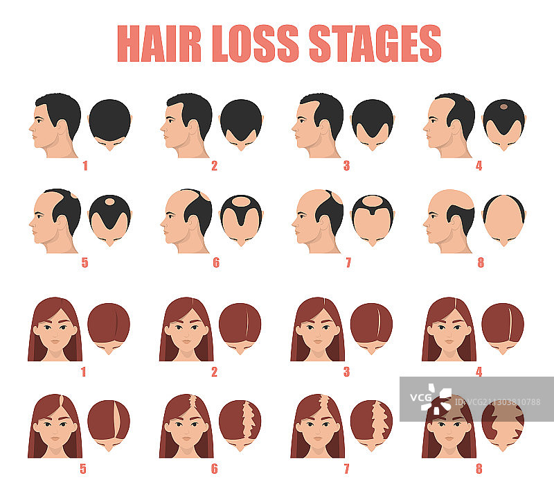 女性和男性的脱发阶段图片素材