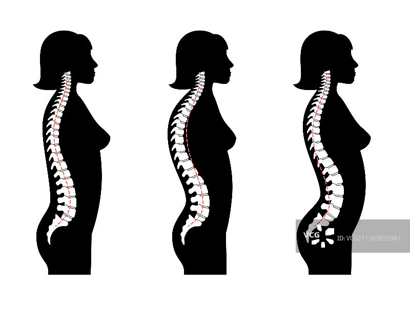 脊柱后凸前凸图片素材