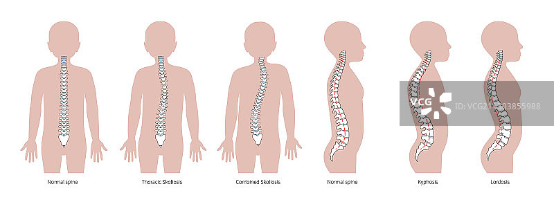 脊柱畸形男孩图片素材