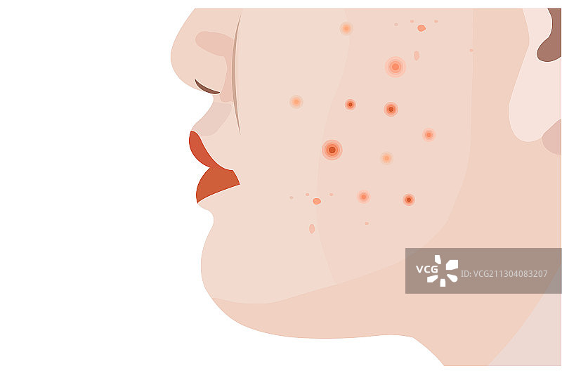 白底女性面部肌肤痘痘图片素材