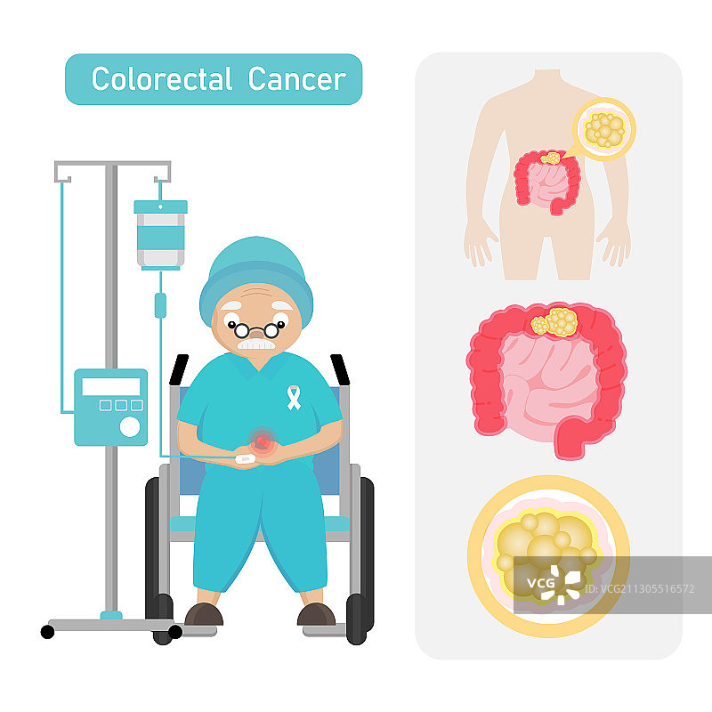患有结直肠癌的年长男性患者图片素材