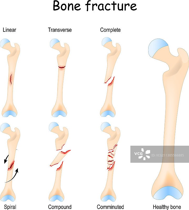 典型的骨折健康股骨和腿部图片素材